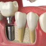 Dental Implants and Improved Forever Oral Health: A Correlation