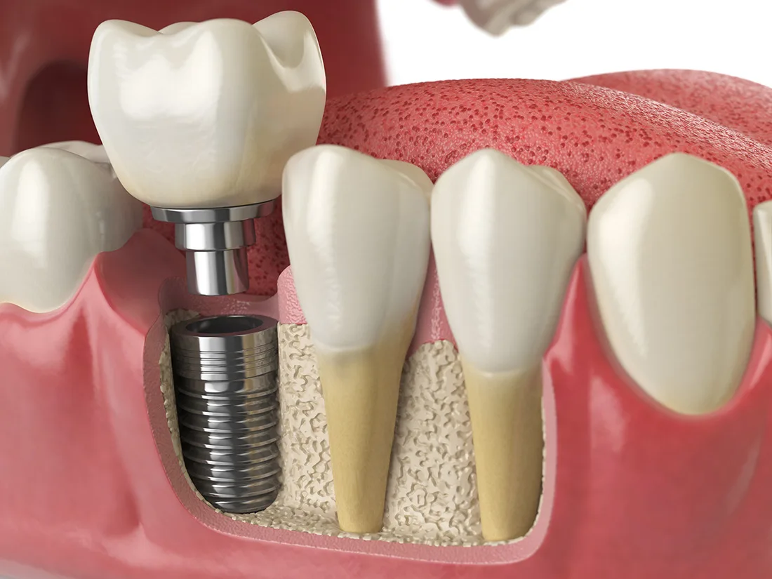 Dental Implants and Improved Forever Oral Health: A Correlation